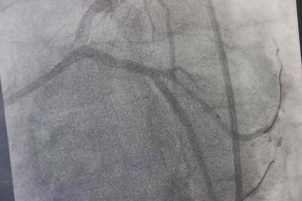 Dünyada yılda 500 bin insanın ölümü trans yağlardan