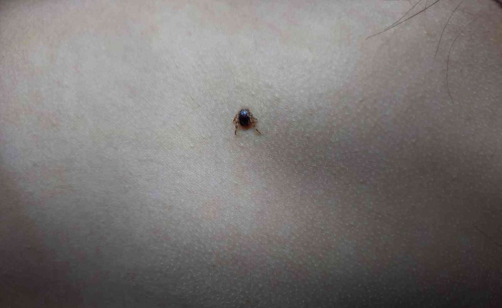 Çocuğun sırtındaki kene hastanede çıkartıldı